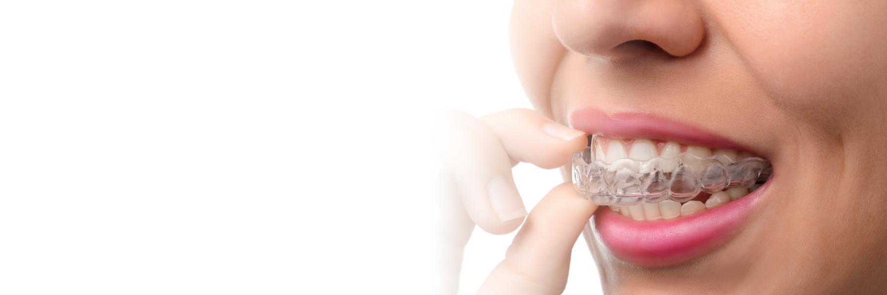 Invisalign | Dentist